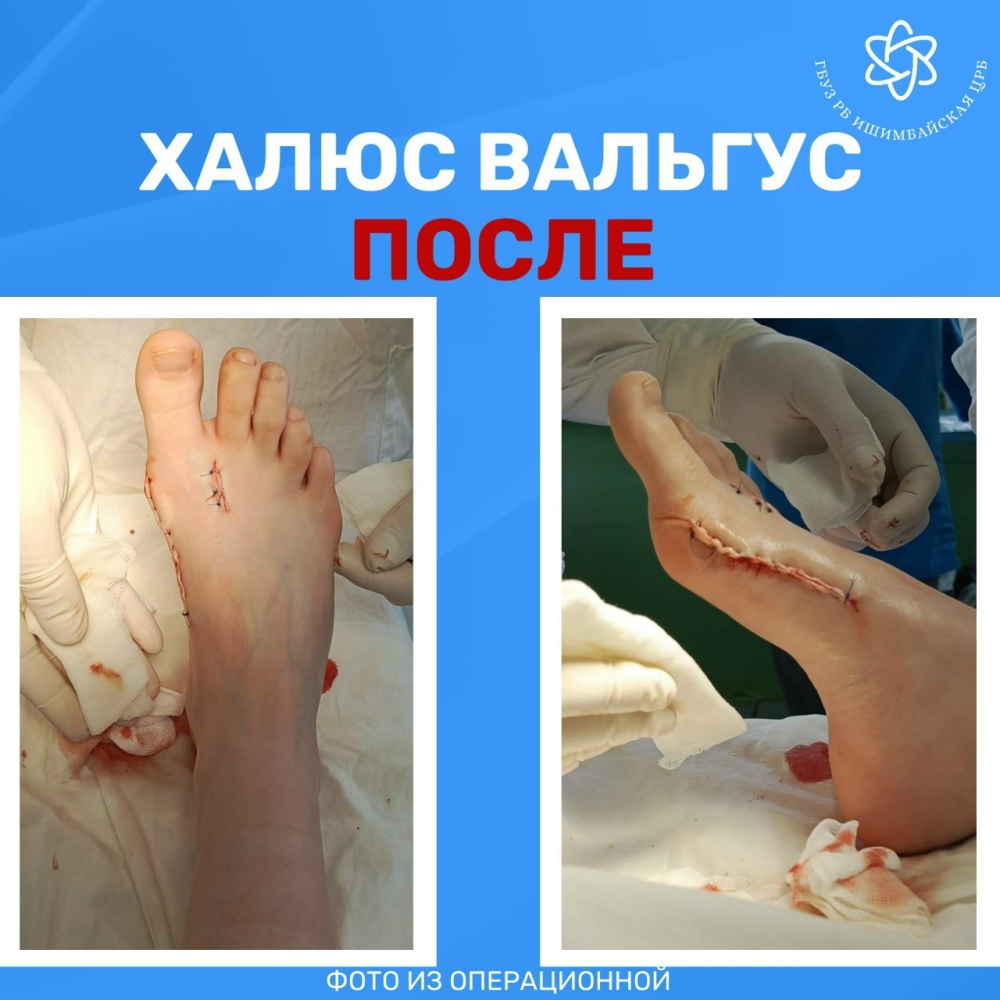 ХАЛЮС ВАЛЬГУС: врачи Ишимбайской больницы провели уникальную операцию по восстановлению стопы